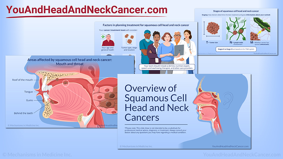 Overview of Squamous Cell Head and Neck Cancers